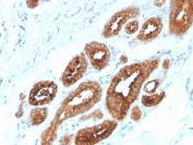 IHC staining of FFPE human breast carcinoma with HER4 antibody (clone ERBB4/2581). HIER: boil tissue sections in 10mM Tris with 1mM EDTA, pH 9, for 10-20 min followed by cooling at RT prior to testing.