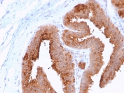 IHC staining of FFPE human breast carcinoma with HER4 antibody (clone ERBB4/2581). HIER: boil tissue sections in 10mM Tris with 1mM EDTA, pH 9, for 10-20 min followed by cooling at RT prior to testing.
