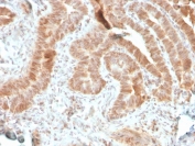 IHC staining of FFPE human colon carcinoma with recombinant AKT1 antibody (clone rAKT1/2491). HIER: boil tissue sections in pH 9 10mM Tris with 1mM EDTA for 10-20 min followed by cooling at RT for 20 min. 