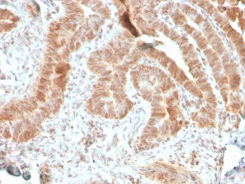 IHC staining of FFPE human colon carcinoma with recombinant AKT1 antibody (clone rAKT1/2491). HIER: boil tissue sections in pH 9 10mM Tris with 1mM EDTA for 10-20 min followed by cooling at RT for 20 min.