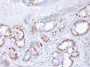 IHC staining of FFPE human breast carcinoma with Estrogen Receptor alpha antibody (clone ESR1/1904). HIER: boil tissue sections in pH 9 10mM Tris with 1mM EDTA for 10-20 min and allow to cool before testing.