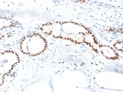 IHC staining of FFPE human breast carcinoma with Estrogen Receptor alpha antibody (clone ESR1/1904). HIER: boil tissue sections in pH 9 10mM Tris with 1mM EDTA for 10-20 min and allow to cool before testing.