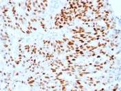 IHC staining of FFPE human endometrial carcinoma with Estrogen Receptor alpha antibody (clone ESR1/1904). HIER: boil tissue sections in pH 9 10mM Tris with 1mM EDTA for 10-20 min and allow to cool before testing.