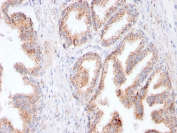 IHC testing of FFPE human prostate cancer with recombinant FOLH1 antibody (clone FOLH1/3149R). HIER: boil tissue sections in pH 9 10mM Tris with 1mM EDTA for 10-20 min and allow to cool before testing.~