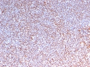 IHC testing of FFPE anaplastic large-cell lymphoma with recombinant ALK antibody (clone ALK/3218R). HIER: boil tissue sections in 10mM Tris buffer with 1mM EDTA, pH 9, for 10-20 min followed by cooling at RT for 20 min.