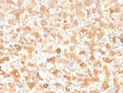 IHC staining of FFPE human liver carcinoma of the colon with Albumin antibody (clone ALB/2355). HIER: boil tissue sections in pH 9 10mM Tris with 1mM EDTA for 20 min and allow to cool before testing.