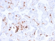 IHC staining of FFPE human placenta with recombinant F13A1 antibody (clone F13A1/3772R). HIER: boil tissue sections in pH 9 10mM Tris with 1mM EDTA for 20 min and allow to cool before testing.