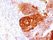 IHC staining of FFPE human colon carcinoma with ALDH1A1 antibody (clone ALDH1A1/1381). HIER: boil tissue sections in pH 9 10mM Tris with 1mM EDTA for 10-20 min and allow to cool before testing.