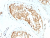 IHC staining of FFPE human testicular carcinoma with ALDH1A1 antibody (clone ALDH1A1/1381). HIER: boil tissue sections in pH 9 10mM Tris with 1mM EDTA for 10-20 min and allow to cool before testing.