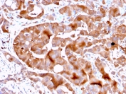 IHC testing of FFPE human liver with FABP5 antibody. HIER: boiling tissue sections in pH 9 10mM Tris with 1mM EDTA for 10-20 min and allow to cool prior to staining.