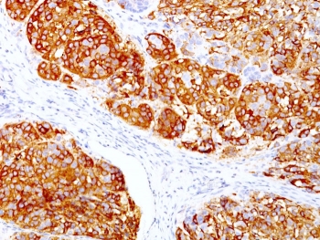 IHC staining of FFPE human melanoma with MART-1 antibody cocktail (clones DT101 + BC199). HIER: boil tissue sections in pH 9 10mM Tris with 1mM EDTA for 10-20 min and allow to cool before testing.~