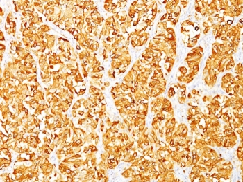 IHC staining of FFPE human melanoma wit