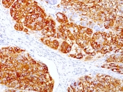 IHC staining of FFPE human melanoma with MART-1 antibody cocktail (clones DT101 + BC199). HIER: boil tissue sections in pH 9 10mM Tris with 1mM EDTA for 10-20 min and allow to cool before testing.