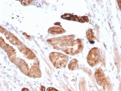 IHC staining of FFPE human breast carcinoma with CD135 antibody (clone FLT3/2458). HIER: boil tissue sections in pH 9 10mM Tris with 1mM EDTA for 10-20 min and allow to cool before testing.