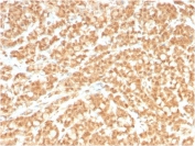 IHC staining of FFPE human colon carcinoma with ICOS Ligand antibody (clone ICOSL/3260). HIER: boil tissue sections in pH 9 10mM Tris with 1mM EDTA for 10-20 min and allow to cool before testing.