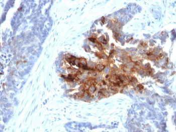 IHC staining of human ovary with recombinant TAG-72 antibody (clone CA72/2869R). HIER: boil tissue sections in pH 9 10mM Tris with 1mM EDTA for 10-20 min and allow to cool before testing.~