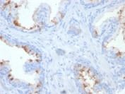 IHC testing of FFPE human prostate carcinoma with FOLH1 antibody (clone FOLH1/2354). Required HIER: boil tissue sections in pH 9 10mM Tris with 1mM EDTA for 10-20 min and allow to cool before testing.