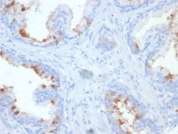IHC testing of FFPE human prostate carcinoma with FOLH1 antibody (clone FOLH1/2354). Required HIER: boil tissue sections in pH 9 10mM Tris with 1mM EDTA for 10-20 min and allow to cool before testing.