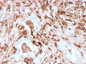 IHC staining of FFPE human pancreas with recombinant FTL antibody (clone rFTL/1388). HIER: boil tissue sections in pH 9 10mM Tris with 1mM EDTA for 10-20 min and allow to cool before testing.
