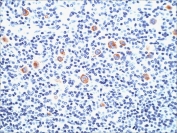 IHC staining of FFPE Hodgkins lymphoma with CD15 antibody (clone SPM119). HIER: boil tissue sections in pH 9 10mM Tris with 1mM EDTA for 10-20 min and allow to cool before testing.