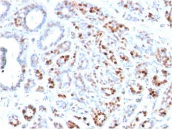 IHC staining of FFPE human breast carcinoma with GATA3 antibody. HIER: boil tissue sections in pH 9 10mM Tris with 1mM EDTA for 10-20 min and allow to cool before testing.