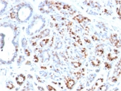 IHC staining of FFPE human breast carcinoma with GATA3 antibody (clone GATA3/2444). HIER: boil tissue sections in pH 9 10mM Tris with 1mM EDTA for 10-20 min and allow to cool before testing.