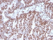 IHC staining of FFPE human breast carcinoma with Estrogen Receptor alpha antibody (clone ESR1/3342). HIER: boil tissue sections in pH 9 10mM Tris with 1mM EDTA for 10-20 min and allow to cool before testing.