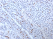 IHC staining of FFPE human breast carcinoma with Estrogen Receptor alpha antibody (clone ESR1/3373). HIER: boil tissue sections in pH 9 10mM Tris with 1mM EDTA for 10-20 min and allow to cool before testing.