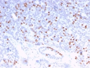IHC staining of FFPE human breast carcinoma with Estrogen Receptor alpha antibody (clone ESR1/3373). HIER: boil tissue sections in pH 9 10mM Tris with 1mM EDTA for 10-20 min and allow to cool before testing.