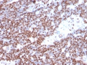 IHC staining of FFPE human breast carcinoma with Estrogen Receptor alpha antibody (clone ESR1/3373). HIER: boil tissue sections in pH 9 10mM Tris with 1mM EDTA for 10-20 min and allow to cool before testing.