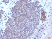 IHC staining of FFPE human breast carcinoma with biotin-conjugated ERa antibody (clone ESR1/3373). HIER: boil tissue sections in pH 9 10mM Tris with 1mM EDTA for 10-20 min and allow to cool before testing.