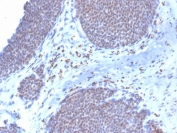 IHC staining of FFPE human breast carcinoma with biotin-conjugated ERa antibody (clone ESR1/3373). HIER: boil tissue sections in pH 9 10mM Tris with 1mM EDTA for 10-20 min and allow to cool before testing.