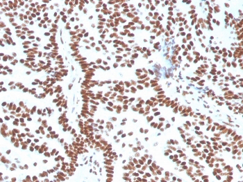 IHC staining of FFPE human breast carcinoma with Estrogen Receptor alpha antibody (clone ESR1/3556). HIER: boil tissue sections in pH 9 10mM Tris with 1mM EDTA for 10-20 min and allow to cool before testing.~