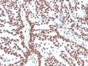 IHC staining of FFPE human breast carcinoma with Estrogen Receptor alpha antibody (clone ESR1/3556). HIER: boil tissue sections in pH 9 10mM Tris with 1mM EDTA for 10-20 min and allow to cool before testing.