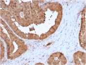 IHC testing of FFPE human prostate carcinoma stained with Glyoxalase 1 antibody (clone CPTC-GLO1-3). Required HIER: boiling tissue sections in pH 9 10mM Tris with 1mM EDTA for 10-20 min followed by cooling at RT for 20 min.