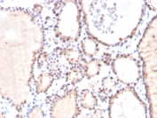 IHC testing of FFPE human thyroid carcinoma stained with Glyoxalase 1 antibody (clone CPTC-GLO1-3). Required HIER: boiling tissue sections in pH 9 10mM Tris with 1mM EDTA for 10-20 min followed by cooling at RT for 20 min.