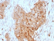 IHC staining of FFPE human breast carcinoma with Glucose 6-Phosphate Isomerase antibody (clone CPTC-GPI-1). HIER: boil tissue sections in pH 9 10mM Tris with 1mM EDTA for 10-20 min and allow to cool before testing.