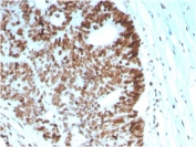 IHC staining of FFPE human colon carcinoma with MSH6 antibody (clone MSH6/2927). HIER: boil tissue sections in pH 9 10mM Tris with 1mM EDTA for 10-20 min and allow to cool before testing.