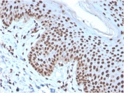 IHC staining of FFPE human skin basal cell carcinoma with recombinant Histone H1 antibody (clone rAE-4). HIER: boil tissue sections in pH 9 10mM Tris with 1mM EDTA for 10-20 min and allow to cool before testing.