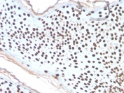 IHC staining of FFPE human skin basal cell carcinoma with recombinant Histone H1 antibody (clone AE-4). HIER: boil tissue sections in pH 9 10mM Tris with 1mM EDTA for 10-20 min and allow to cool before testing.