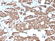 IHC staining of FFPE human breast carcinoma with recombinant Histone H1 antibody (clone AE-4). HIER: boil tissue sections in pH 9 10mM Tris with 1mM EDTA for 10-20 min and allow to cool before testing.