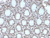 IHC staining of FFPE human colon carcinoma with recombinant Histone H1 antibody (clone AE-4). HIER: boil tissue sections in pH 9 10mM Tris with 1mM EDTA for 10-20 min and allow to cool before testing.