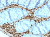 IHC staining of FFPE human colon carcinoma with Annexin A1 antibody (clone ANXA1/3566). HIER: boil tissue sections in pH 9 10mM Tris with 1mM EDTA for 10-20 min and allow to cool before testing.