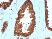 IHC staining of FFPE human prostate carcinoma with Annexin A1 antibody (clone ANXA1/3566). HIER: boil tissue sections in pH 9 10mM Tris with 1mM EDTA for 10-20 min and allow to cool before testing.