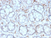 IHC staining of FFPE human colon carcinoma with recombinant CD209 antibody (clone rC209/1781). HIER: boil tissue sections in pH 9 10mM Tris with 1mM EDTA for 10-20 min and allow to cool before testing.
