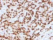 IHC testing of FFPE human prostate with FOXA1 antibody (clone FOXA1/1516). HIER: steam sections in pH 9 10mM Tris with 1mM EDTA for 10-20 min and allow to cool before testing.