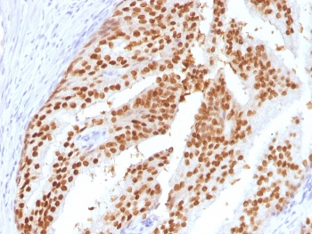 IHC testing of FFPE human PIN (Prostatic Intraepithelial Neopplasia) with FOXA1 antibody (clone FOXA1/1516). HIER: steam sections in pH 9 10mM Tris with 1mM EDTA for 10-20 min and allow to cool before testing.