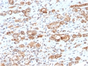 IHC staining of FFPE human renal cell carcinoma with HSP60 antibody (clone CPTC-HSPD1-1). HIER: boil tissue sections in pH 9 10mM Tris with 1mM EDTA for 10-20 min and allow to cool before testing.