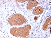 IHC staining of FFPE human breast carcinoma with HSP60 antibody (clone CPTC-HSPD1-1). HIER: boil tissue sections in pH 9 10mM Tris with 1mM EDTA for 10-20 min and allow to cool before testing.