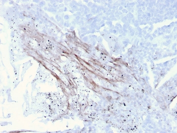 IHC staining of FFPE human lung carcinoma with Tenascin C antibody (clone rTNC/3635). HIER: boil tissue sections in pH 9 10mM Tris with 1mM EDTA for 10-20 min and allow to cool before testing.~